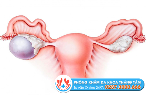 U nang buồng trứng - bệnh lý làm tăng nguy cơ vô sinh ở nữ