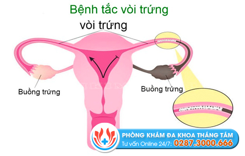 Tắc vòi trứng dễ gây vô sinh, mang thai ngoài tử cung