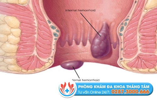 Bệnh trĩ là gì