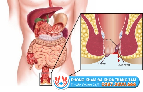 Những cách thông dụng để điều trị bệnh trĩ